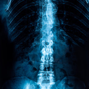 X ray of a human spine - Ideal Spine Health Center