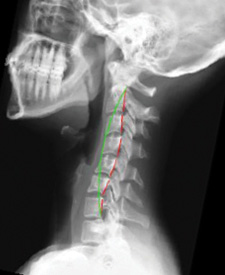 X Ray of a Bad Spine