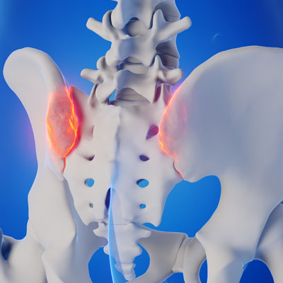 Understanding Sacroiliitis