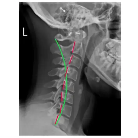 correcting neck curve