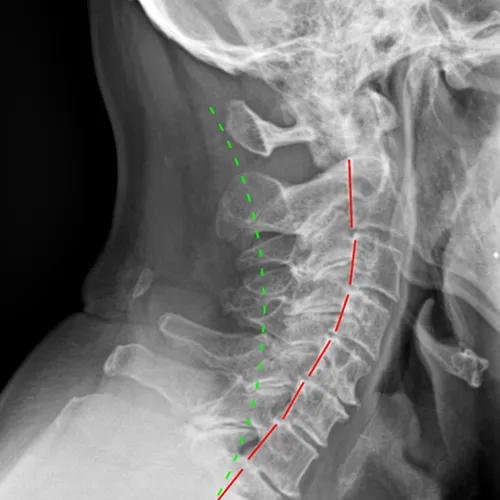 Correcting abnormal posture